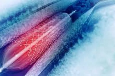 Angioplasty Balloons Market Trends, Size, Forecast - 2018-2023
