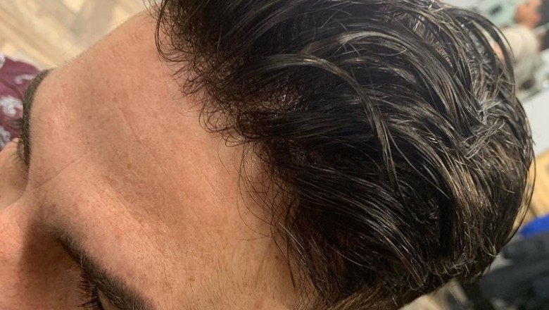 How to address male pattern alopecia