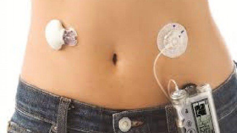 Global Disposable Medical Sensor Market Trends, Size, Forecast - 2019-2025