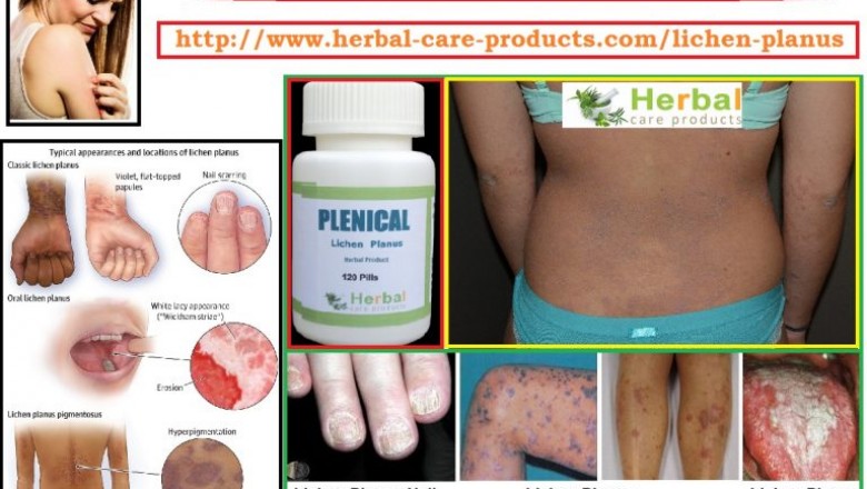 10 Natural Remedies for Lichen Planus