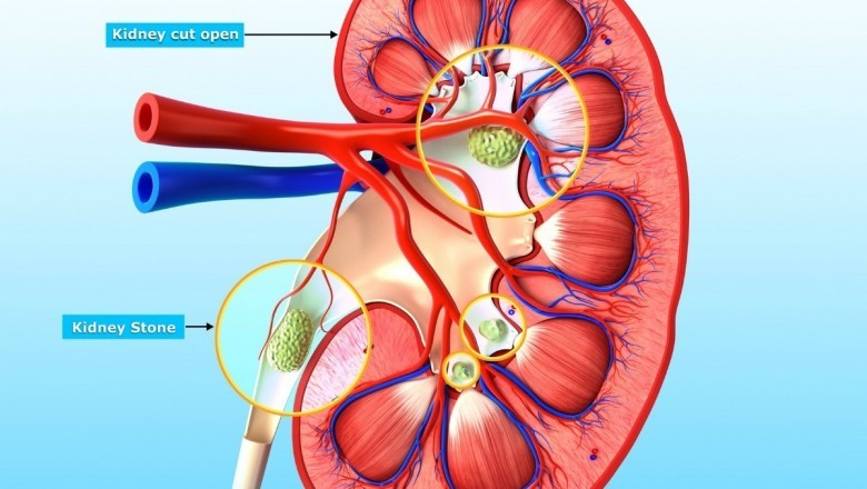 Kidney Supplement Helps Stop Calcium Oxalate Crystal & Stone Formation | Kidney COP®