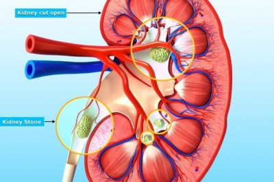 Kidney Supplement Helps Stop Calcium Oxalate Crystal & Stone Formation | Kidney COP®