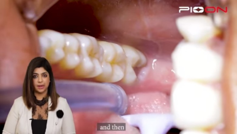 Excision of soft tissue Operculectomy by Pioon S1 Dental Diode Laser