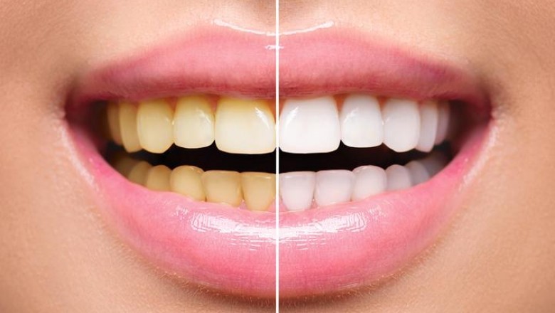 Best Teeth Whitening Strips