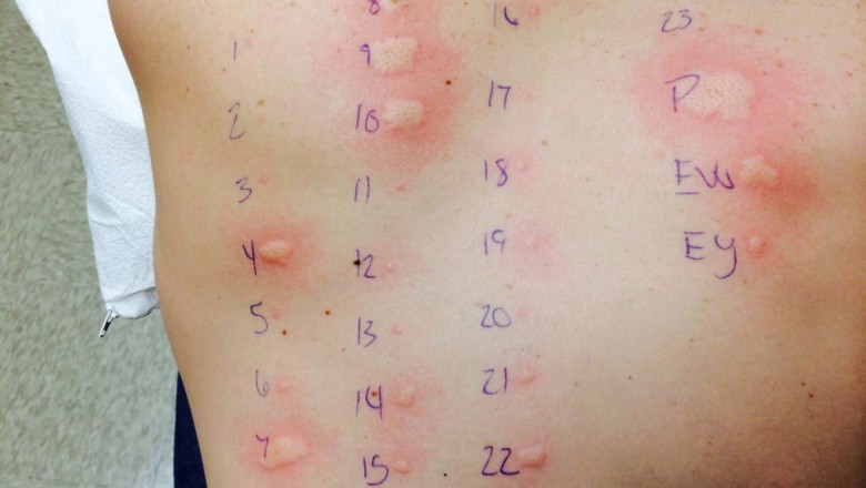 Food Allergy Testing