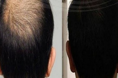 hair Weaving Cost in Bangalore