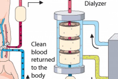 Hemodialysis Market by Global Size, Trends and Research Analysis 2020 to 2030