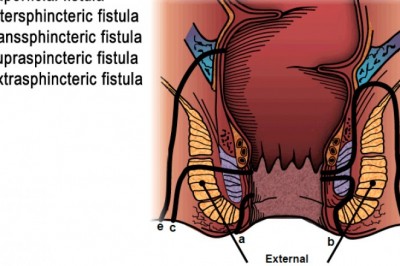 Fistula hospital Ahmedabad