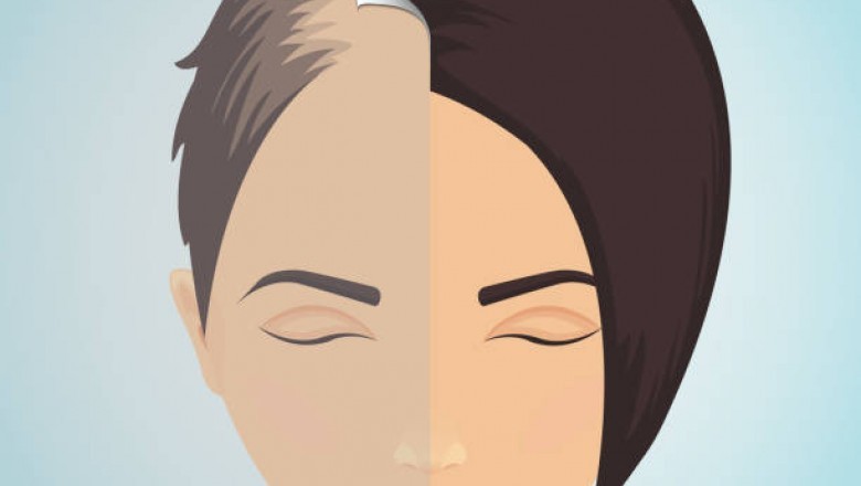 Hair Loss Treatment in London