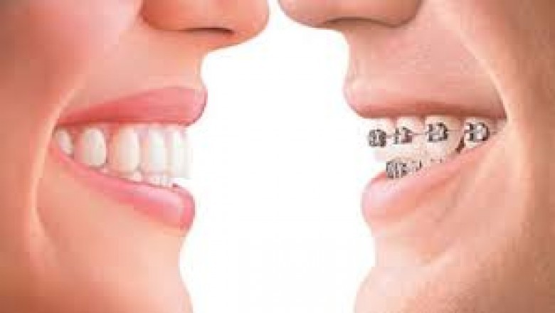 Invisalign Treatment cost - How Much is Invisalign Treatment