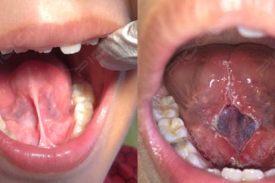 Management of Tongue-Tie/Ankyloglossia - A Surgical Procedure with Dental Laser