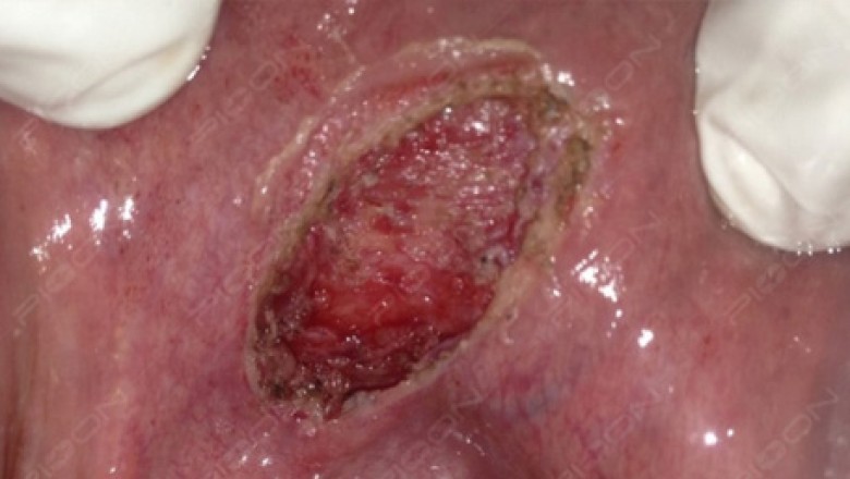 How to treat oral mucous cysts