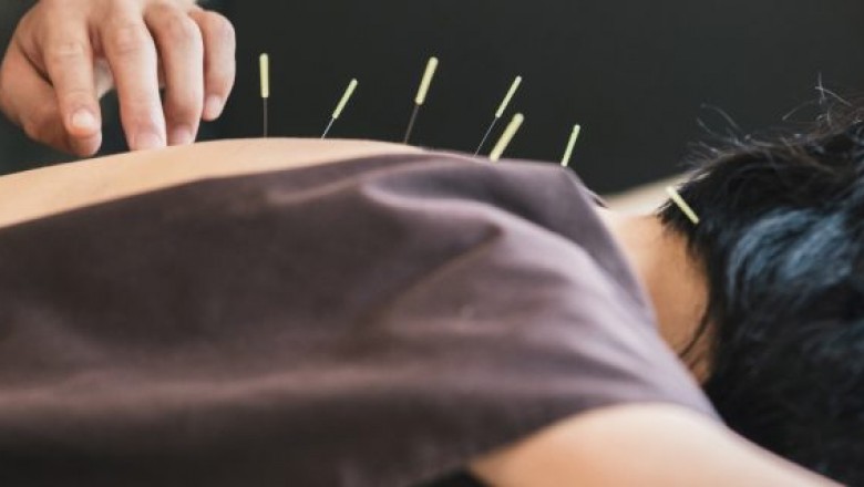 Know More About Acupuncture Therapy