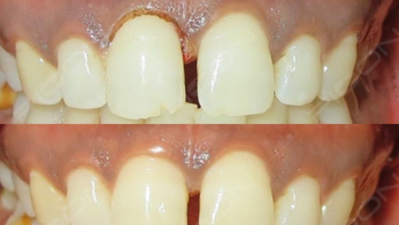 Gingivoplasty Using Diode Laser