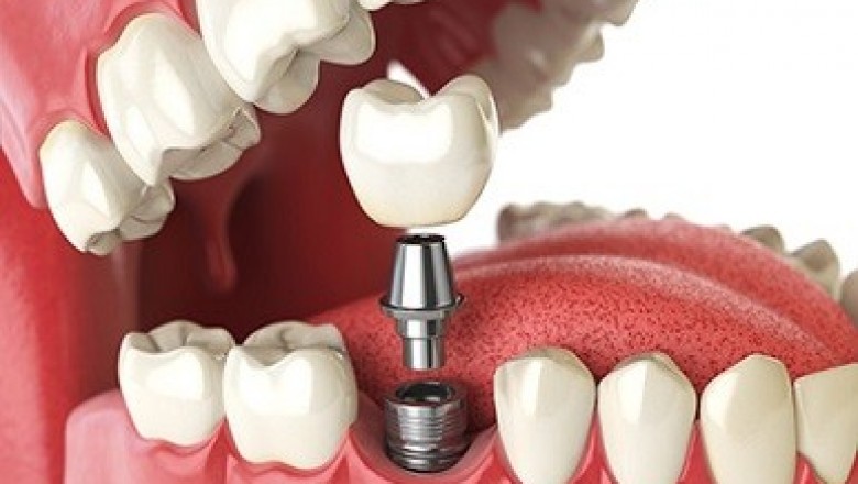 Dental Biomaterial Market is projected to grow at CAGR 7.41%