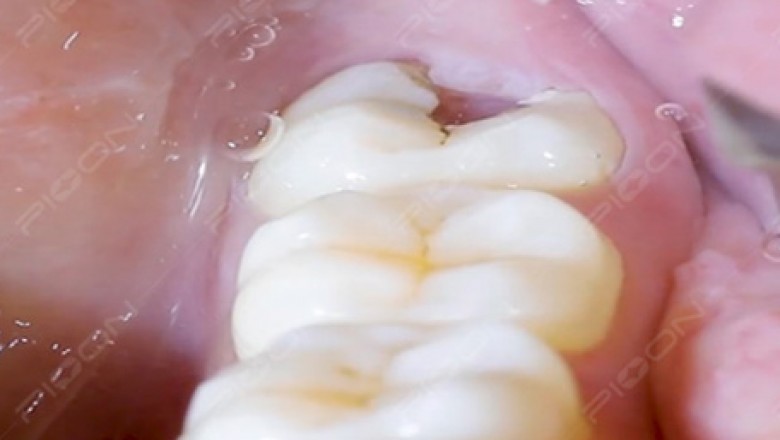 Management of Pericoronitis using Dental Diode Laser
