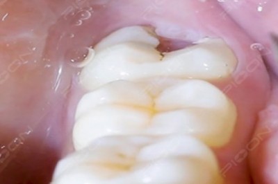 Management of Pericoronitis using Dental Diode Laser