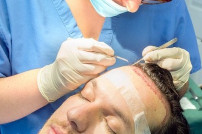 Hair Transplant: What To Know And How Does It Works?