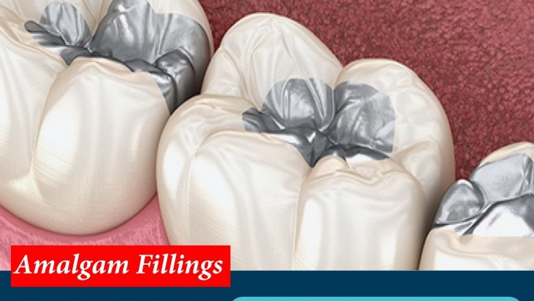 Amalgam Fillings | Emergency Dental Services in United States