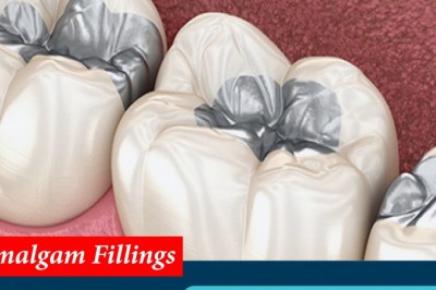 Amalgam Fillings | Emergency Dental Services in United States