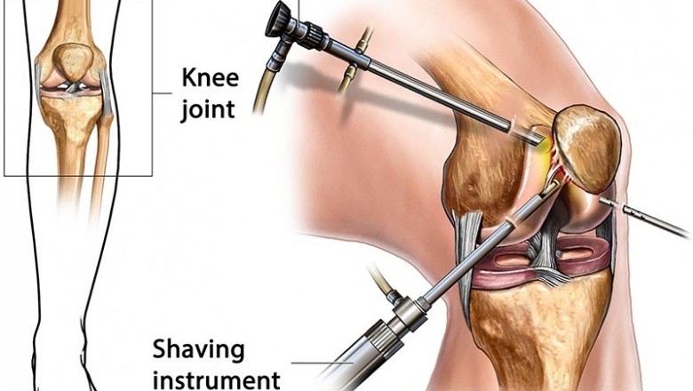 Arthroscopy Devices Market by Competitive Landscape and Demand 2020 to 2030