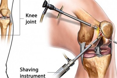 Arthroscopy Devices Market  by Competitive Landscape and Demand 2020 to 2030