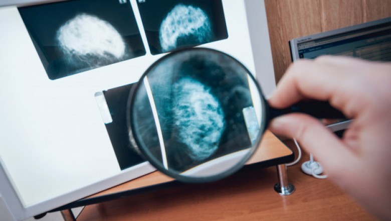 Global Neuroendocrine Tumor Treatment Market Forecast