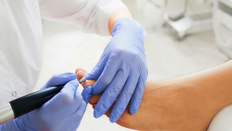 Exactly where to acquire a Fungal Nail Treatment
