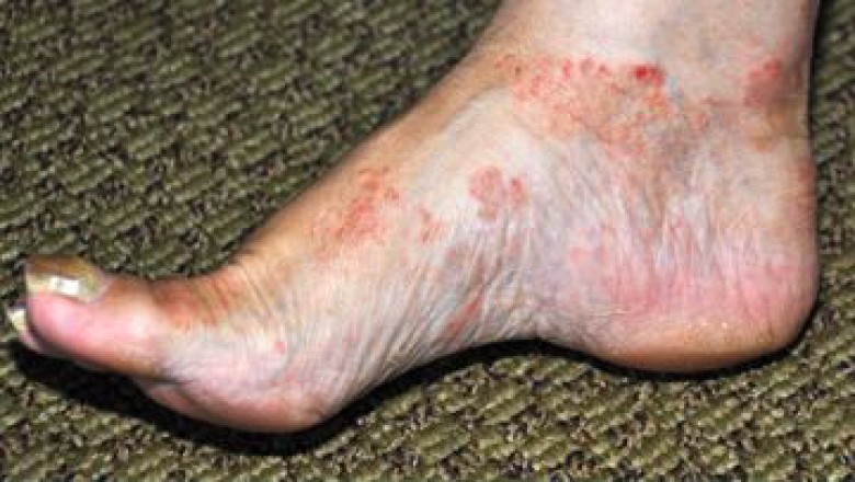 Increasing Geriatric Population and High Prevalence of Vasculitis Boosts Demand for Vasculitis Treatment in US