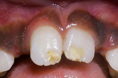 Management of Unerupted Lateral Incisor by LASER Assisted Surgical Exposure