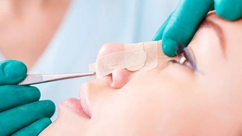 All You Need to Know About Revision Rhinoplasty