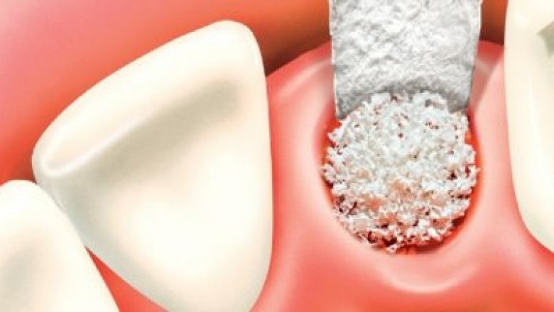 Increasing Focus on Aesthetic Appeal to Augment Growth of the Dental Bone Graft and Substitutes Market