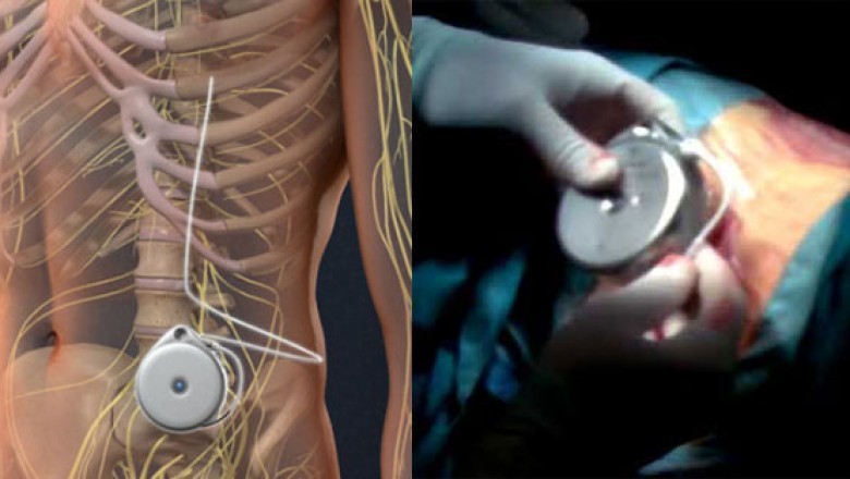 Intrathecal Pumps Effective in Treatment and Management of Cancer, Chronic Pain, and Other Conditions