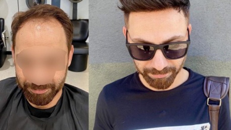 Why to Buy China's Inexpensive Human Men`s Hair System