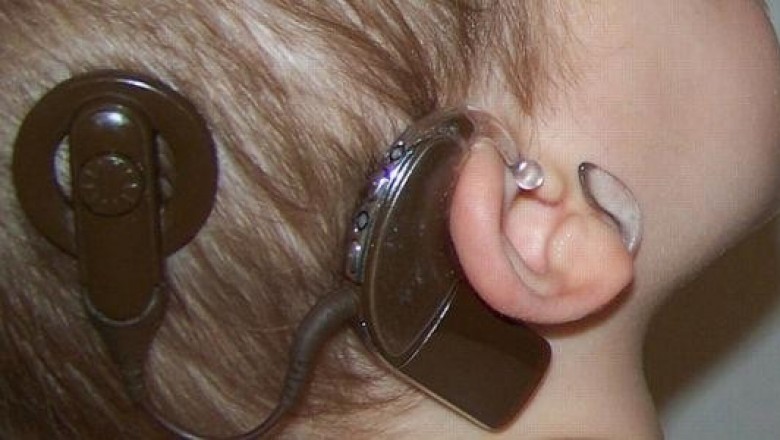 Binaural Cochlear Implant Market Size, Share, Outlook, and Opportunity Analysis, 2018– 2026