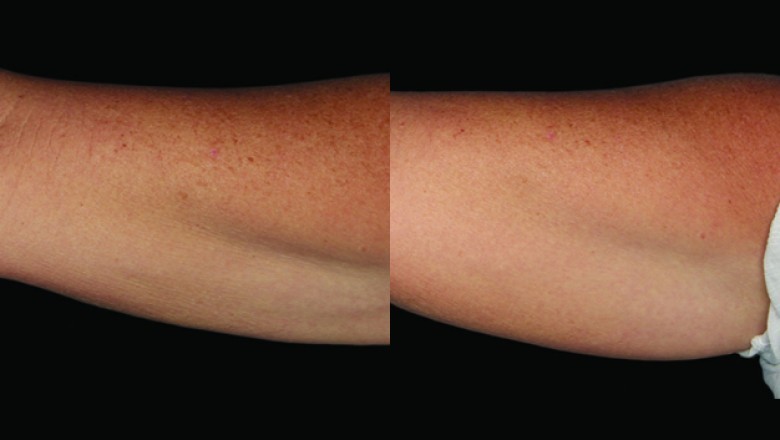 Coolsculpting cost