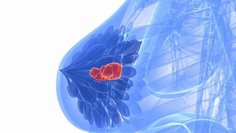 Breast Imaging Market To Surpass US$ 7,287.1 Million By 2026 - Coherent Market Insights