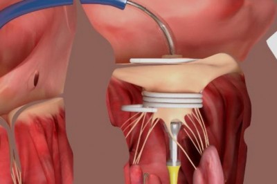 Reparation and reconstruction of the transcatheter mitral valve and an emerging invasive procedure play an important role in improving heart health