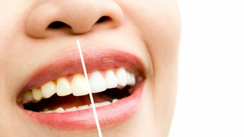 Beautiful Smile by Teeth Whitening
