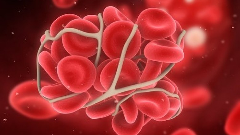 Antithrombin; an important blood clotting proteinase anticoagulant regulator