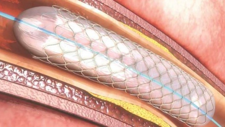 Biodegradable Stents Market To Surpass US$ 0.8 Billion By 2026 - Coherent Market Insights