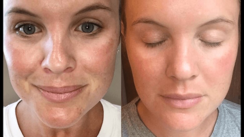Platelet Rich Plasma (PRP) for Skin Rejuvenation Therapy