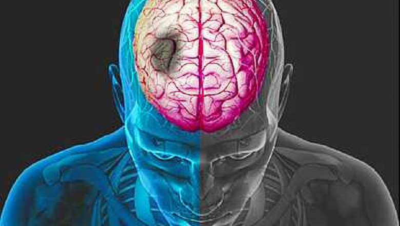 Stroke Management Market Size, Trends, Shares, Insights and Forecast – 2018-2026