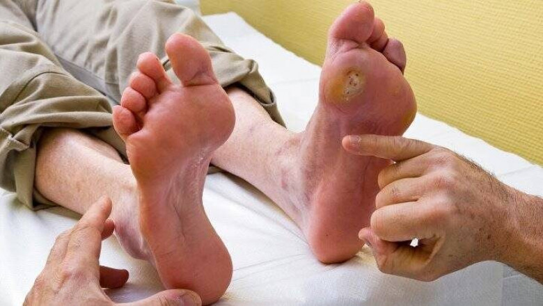 Diabetic Foot Ulcer Therapeutics Market Opportunity Analysis-2027