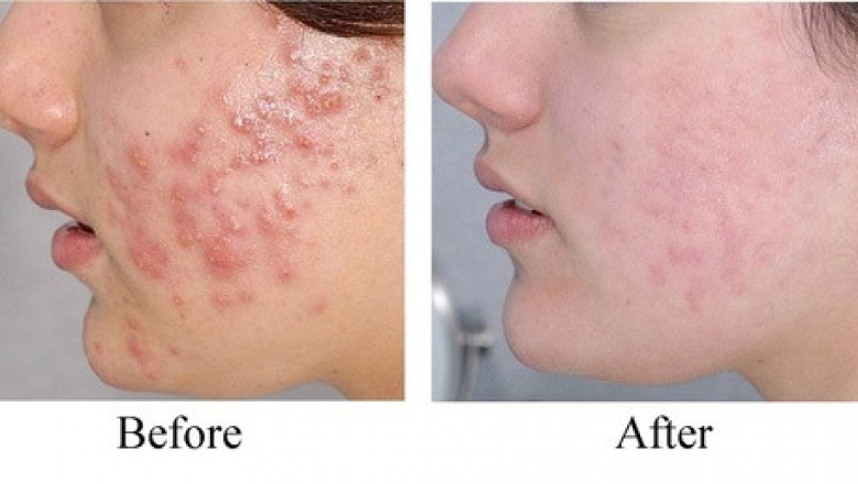 Acne Vulgaris Treatment Market Size, Trends, Shares, Insights and Forecast – 2018-2026