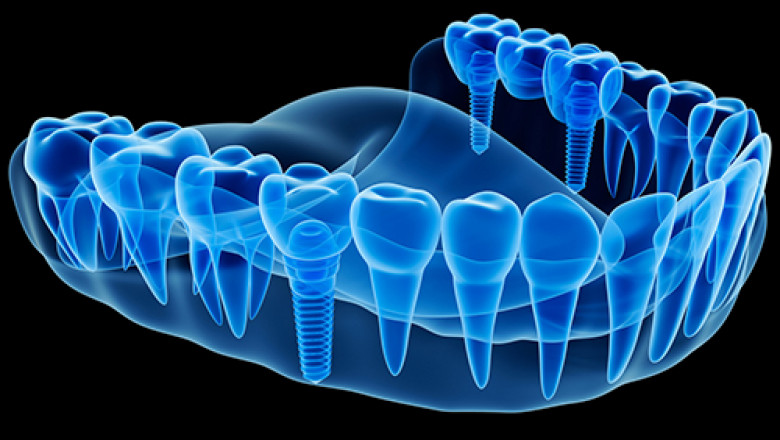 Should You Worry About a Missing Tooth?