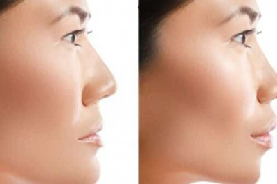 Broken and Defective Jaw Surgery in Charlotte NC