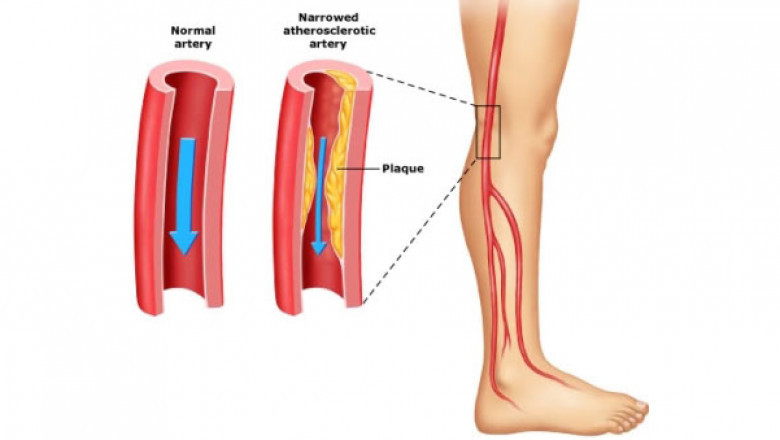 Peripheral Artery Disease Market Global Outlook 2021 to 2030