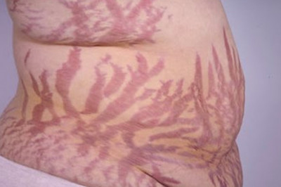 Antipsychotic Drugs are Commonly Prescribed to Treat Symptoms of Cushing's Syndrome.