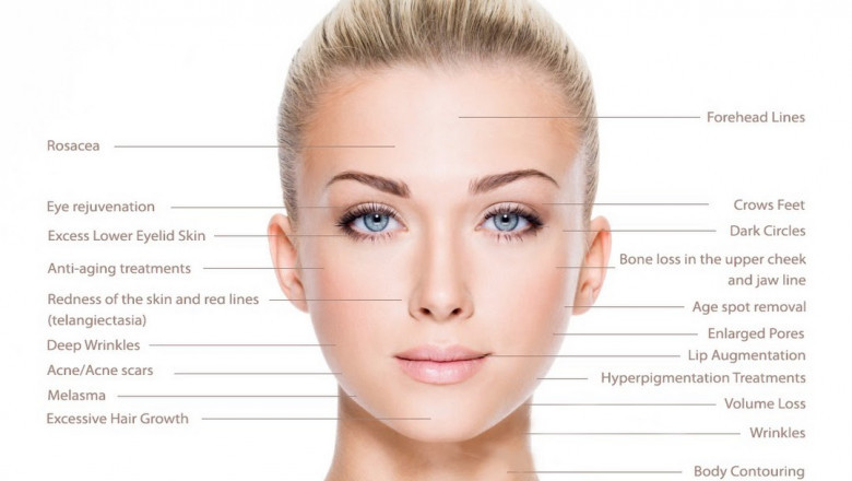 Radiesse Filler London